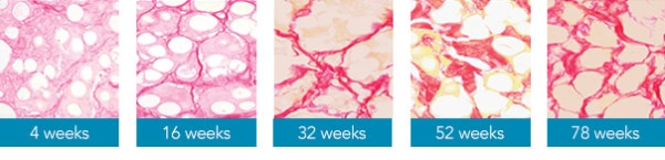 process of neocollagenesis